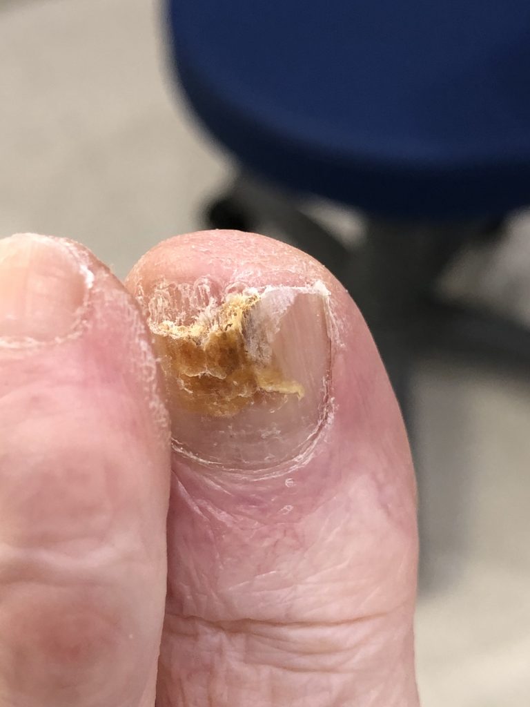 Fungal Nails New Treatment Werribee Foot Clinic